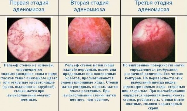 Как развивается эндометриоз 1 степени