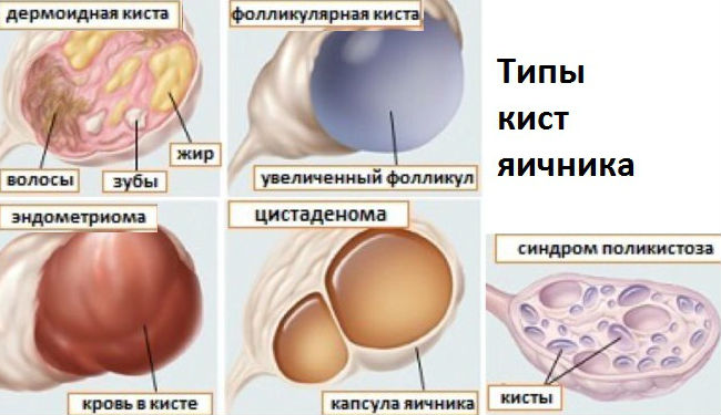 Киста яичника симптомы и лечение