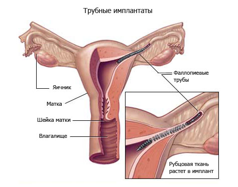 Установление трубных имплантов