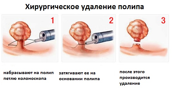 Как происходит удаление образований