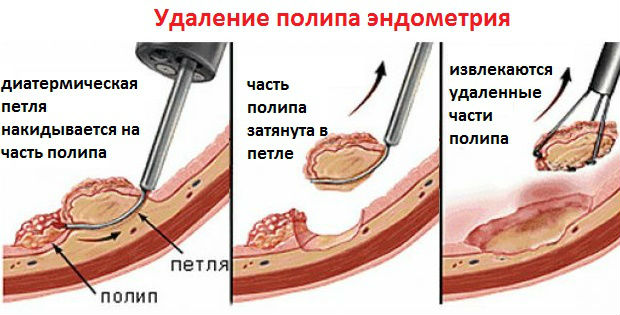 Интимное здоровье :: Удаление полипа эндометрия: методы, противопоказания