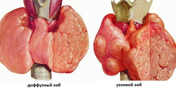 Болезни :: Зоб щитовидной железы: разновидности, симптомы, лечение