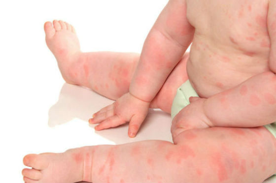 Уход за детьми :: Пищевая аллергия у ребенка: проявления, лечение, перечень продуктов-аллергенов