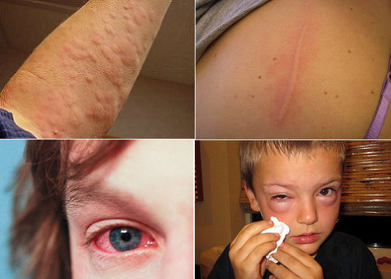 Уход за детьми :: Аллергия на кошек у детей: симптомы, диагностика, лечение. Советы по уходу за животным, гипоаллергенные породы