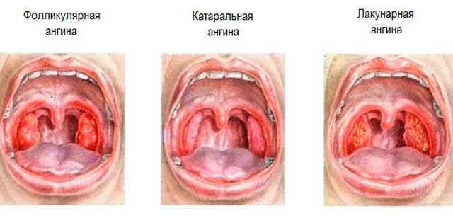 Ангина у ребенка лечение профилактика фото Ангина у ребенка лечение профилактика фото