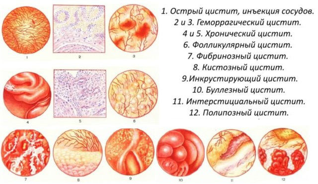 Уход за детьми :: Цистит у детей: виды, симптомы, лечение, осложнения и профилактика