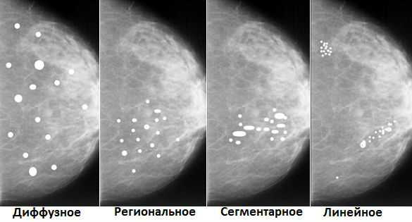 Виды мелких кальцинатов в женской груди