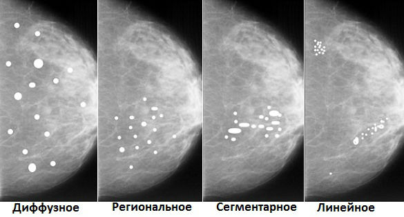 Болезни :: Микрокальцинаты в молочной железе: что это такое, виды, лечение