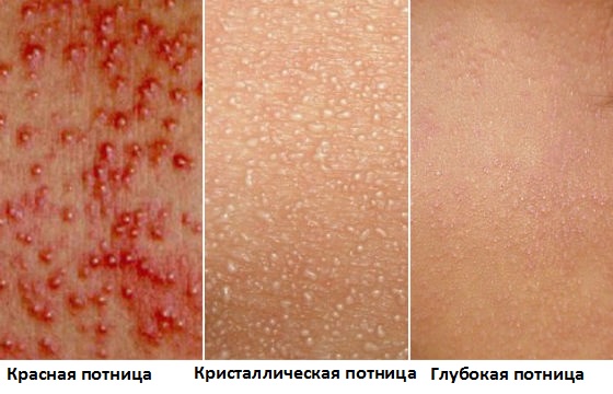 Потница у детей фото симптомы и лечение. Мази и крема от потницы 95 Потница у детей фото симптомы и лечение. Мази и крема от потницы 97