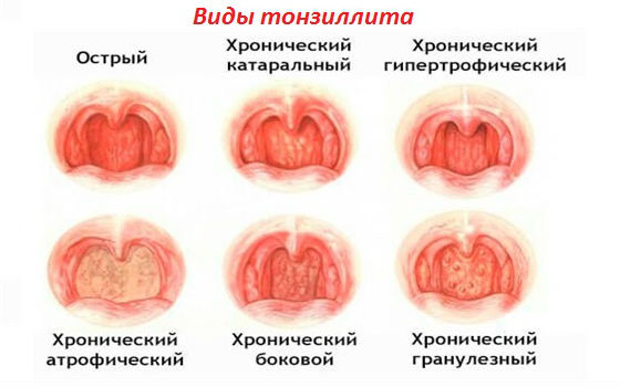 Уход за детьми :: Тонзиллит у детей: виды, симптомы, лечение и осложнения