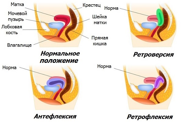 Разновидности отклонений матки