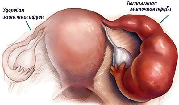 Воспаление маточной трубы заметно на УЗИ