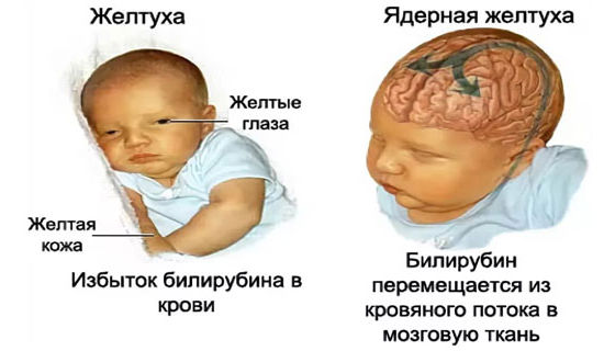 Механизм поражения ядер мозга билирубином