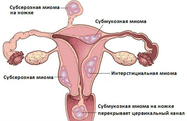 Месячные идут сгустками крови что это значит