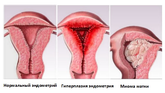 Сгустки крови при месячных причины Сгустки крови при месячных причины
