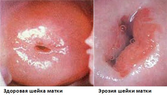 Когда делают прижигание эрозии шейки матки
